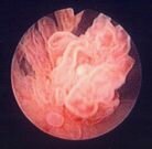 Эндофото папилломы мочевого пузыря